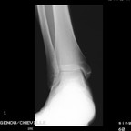 Ostéome ostoïde du bord supéro-médial du dôme talien Radiographie Cheville face Ostéome ostoïde du bord supéro-médial du dôme talien Radiographie Cheville face