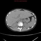 Tumeur pancréatique solide pseudo-papillaire TDM Abdomen Axial Sans injection Tumeur pancréatique solide pseudo-papillaire TDM Abdomen Axial Sans injection
