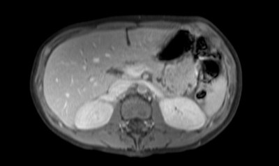 Phéochromocytome et paragangliome dans un contexte de maladie de Von Hippel Lindau ser012img00001
