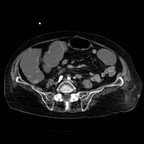 Ulcère hémorragique du bulbe. TDM Abdomen Axial Temps artériel Ulcère hémorragique du bulbe. TDM Abdomen Axial Temps artériel