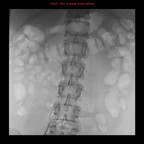 Repéchage de corps étranger par lasso Interventionnel Abdomen Face Repéchage de corps étranger par lasso Interventionnel Abdomen Face