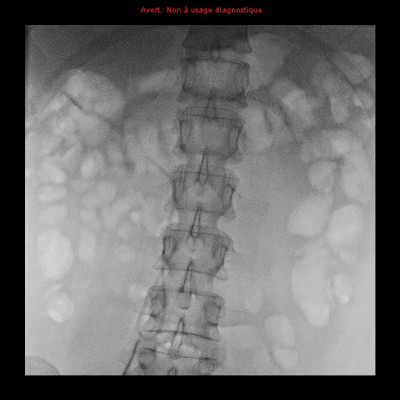 Repéchage de corps étranger par lasso  Interventionnel Abdomen Face