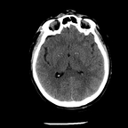 Craniocerebral trauma, Carotid artery injury with dissection, traumatic perforation of GI tract, pulmonary artery injury, Chance fracture Head CT, Axial plane, Soft tissue window Craniocerebral trauma, Carotid artery injury with dissection, traumatic perforation of GI tract, pulmonary artery injury, Chance fracture Head CT, Axial plane, Soft tissue window