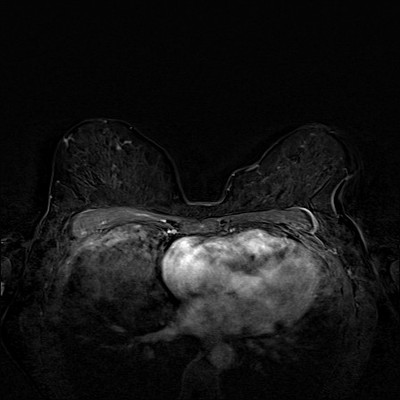 Carcinome canalaire in situ supéro-médian droit Soustraction 1 min