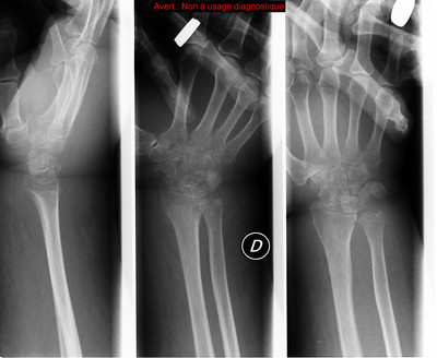 Chondrocalcinose  Radiographie Membre supérieur