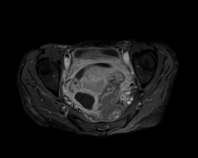 Rectal obstruction due to endometriosis Axial T1 Gado FatSat