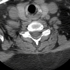 Cervical facet joint chondrocalcinosis C6/C7 Cervical facet joint chondrocalcinosis C6/C7