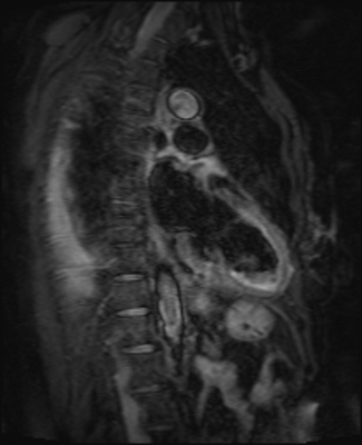 Syndrome de Tako-Tsubo - Myocardite adrénergique T2 spir