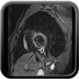 Myocardite virale T2 dark blood avec saturation de la graisse
