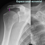 Rupture de la coiffe des rotateurs Espace-sous-acromial-rupture-coiffe-des-rotateurs Rupture de la coiffe des rotateurs Espace-sous-acromial-rupture-coiffe-des-rotateurs