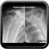 Rupture de la coiffe des rotateurs Espace-sous-acromial-rupture-coiffe-des-rotateurs