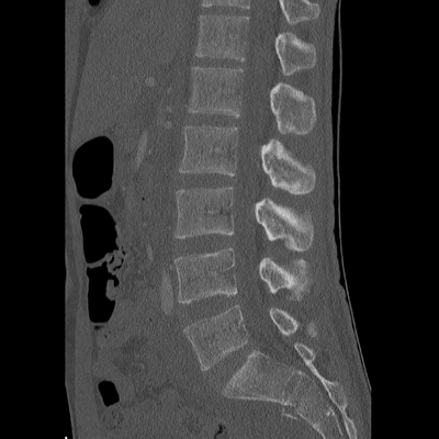 Thoracic Injuries, Subcapsular hemorrhage of liver, Pelvic injury Lumbar spine, Bone window