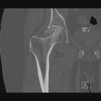 Ostéonécrose de la tête fémorale TDM hanche Coronal MPR fenêtre os Ostéonécrose de la tête fémorale TDM hanche Coronal MPR fenêtre os
