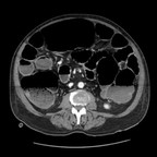 Occlusion mécanique colique sur sténose inflammatoire pseudo-tumorale secondaire à une diverticulite du sigmoïde Axial Occlusion mécanique colique sur sténose inflammatoire pseudo-tumorale secondaire à une diverticulite du sigmoïde Axial
