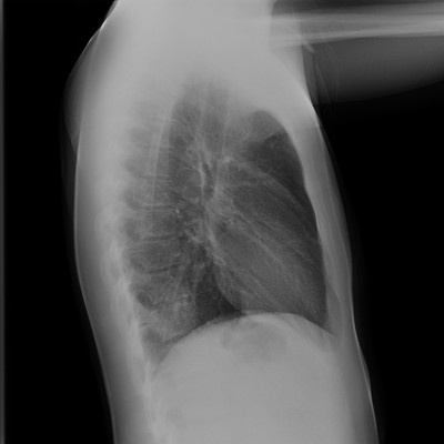 Pneumopathie infectieuse de la base droite Thorax profil