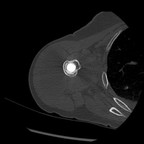 Déscellement granulomateux de la prothèse. TDM Membre supérieur Axial Déscellement granulomateux de la prothèse. TDM Membre supérieur Axial