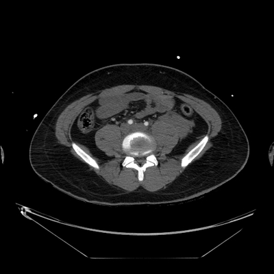 hernie diaphragmatique, traumatisme thoracique, traumatisme abdominal, burst fracture, fracture du pied TAP-MI arétriel axial