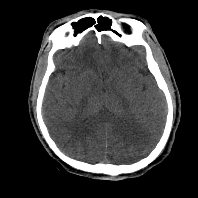 Thoracic Injuries, Subcapsular hemorrhage of liver, Pelvic injury Head CT, Axial plane