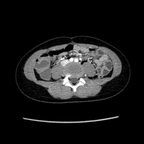 Retro péritoine d'origine traumatique TDM Abdomen Axial Temps veineux Retro péritoine d'origine traumatique TDM Abdomen Axial Temps veineux