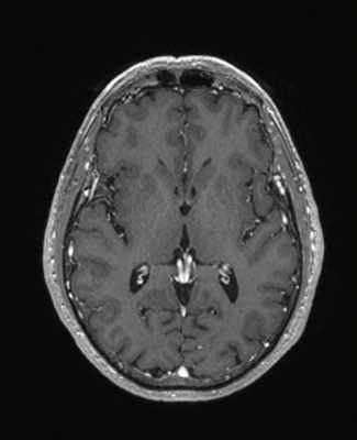 Schwannome cochléovestibulaire (neurinome de l'acoustique) T1 3D GADO AXIAL