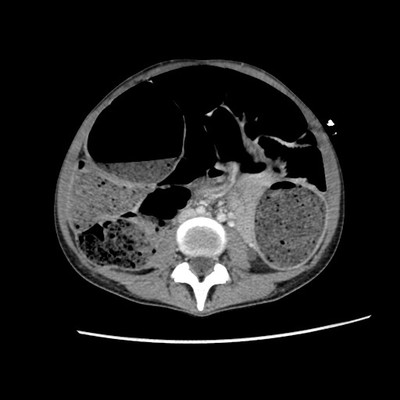 Occlusion mécanique colique sur endométriose digestive TDM Axial Portal