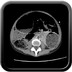 Occlusion mécanique colique sur endométriose digestive TDM Axial Portal
