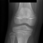 Ménisque discoïde latéral bilatéral Radiographie Jambe Face Ménisque discoïde latéral bilatéral Radiographie Jambe Face