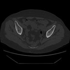 Chondrocalcinose TDM fenetrage os Chondrocalcinose TDM fenetrage os