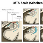 MTA-scale for Medial Temporal lobe Atrophy (Scheltens) scheltens-mta-scale MTA-scale for Medial Temporal lobe Atrophy (Scheltens) scheltens-mta-scale