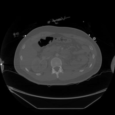 hernie diaphragmatique, traumatisme thoracique, traumatisme abdominal, burst fracture, fracture du pied TAP axial os