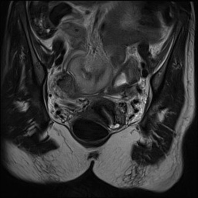 Rectal obstruction due to endometriosis Coronal T2