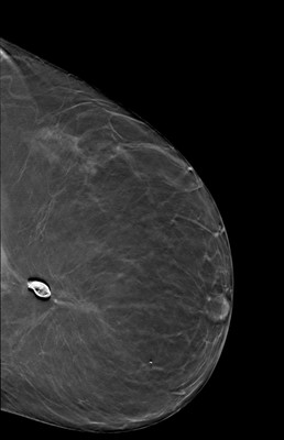 Récidive tardive de cancer du sein gauche LCC Tomosynthèse