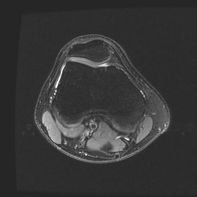 bipartite patella  MRI Lower limb Axial Fat Sat DPw