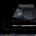Torsion annexielle gauche sur défect du ligament large Echographie Torsion annexielle gauche sur défect du ligament large Echographie