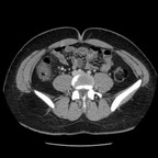 Infarctus sur torsion du grand epiploon TDM Abdomen Axial Temps veineux Infarctus sur torsion du grand epiploon TDM Abdomen Axial Temps veineux
