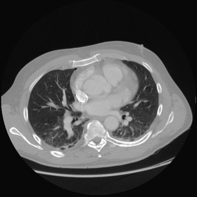 Subarachnoid Hemorrhage, Traumatic, Pneumothorax, Sternum fracture Axial plane, Lung window