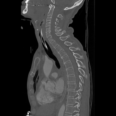 Craniocerebral trauma, Carotid artery injury with dissection, traumatic perforation of GI tract, pulmonary artery injury, Chance fracture Cervical and dorsal spine, Sagittal plane, Bone window