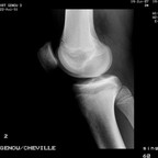Fissuration en anse de seau du ménisque médial Radiographie Fissuration en anse de seau du ménisque médial Radiographie