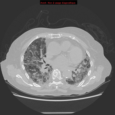 Pneumopathie interstitielle fibrosante à la cordarone  TDM Thorax Axial expiration