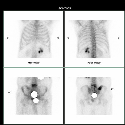 Néoplasie prostatique multimétastatique Scintigraphie osseuse