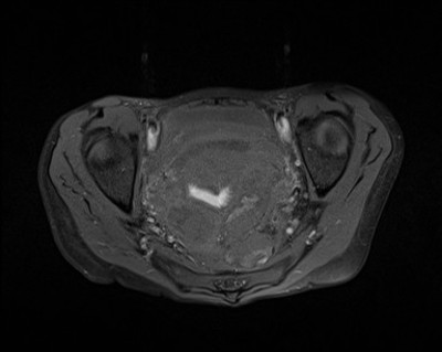 Rectal obstruction due to endometriosis Axial T1 FatSat