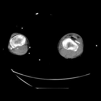 Cranioencephalic injuries, limb injuries, aspiration pneumonia Lower limbs, Arterial phase, Axial plane
