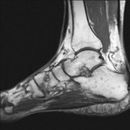 Enthésopathie achiléenne avec clivage intra-tendineux T1 Sagittal Enthésopathie achiléenne avec clivage intra-tendineux T1 Sagittal