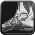 Enthésopathie achiléenne avec clivage intra-tendineux T1 Sagittal