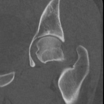 Thoracic Injuries, Subcapsular hemorrhage of liver, Pelvic injury Left hip, Coronal plane, Bone window