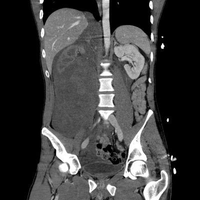 Renal vein rupture, Adrenal hemorrhage Abdomen CT, Portal venous phase, Coronal plane