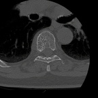 Aggressive vertebral angioma of T6 D5-D6-D7 AXIAL OS Aggressive vertebral angioma of T6 D5-D6-D7 AXIAL OS