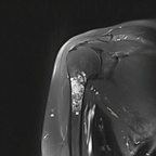 Enchondroma of the proximal humerus Coronal T2 Fat Sat MRI Enchondroma of the proximal humerus Coronal T2 Fat Sat MRI
