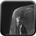 Enchondroma of the proximal humerus Coronal T2 Fat Sat MRI