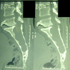 KYSTE ARACHNOIDIEN DU SACRUM TDM KYSTE ARACHNOIDIEN DU SACRUM TDM